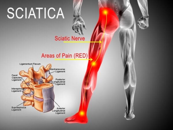 WHAT ARE SYMPTOMS OF SCIATIC PAIN?