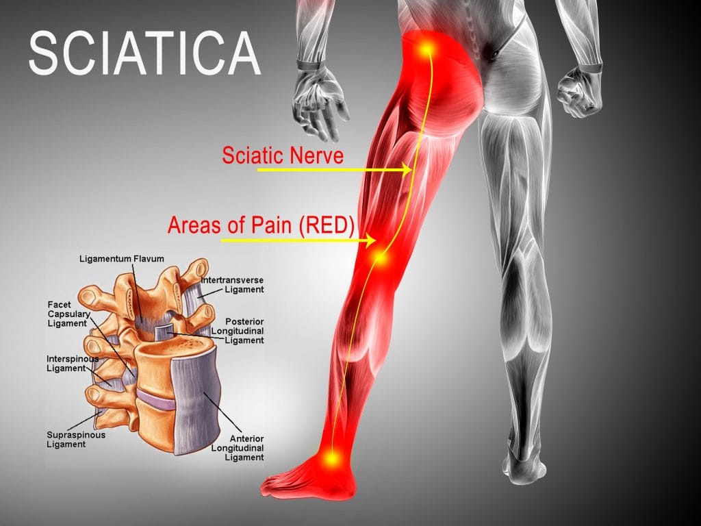 5 Exercises To Ease Sciatic Nerve Pain